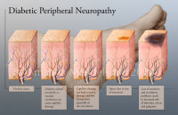 Diabetic Neuropathy CAN Be Treated! 6 Natural Solutions