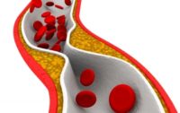 Cholesterol Lowering Statin Drugs Increase Progression of Coronary Artery Calcification