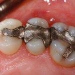 How dental amalgam fillings destroy gut health and cause heart disease