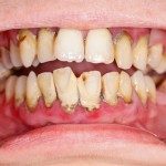 Gum disease found to greatly increase risk of cognitive decline