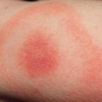 Lyme disease warning: Myths and facts revealed