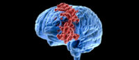 Radiation therapy for brain cancer found to cause significant damage to the brain