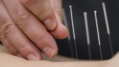 Acupuncture found to promote weight loss by boosting appetite-suppressing hormones