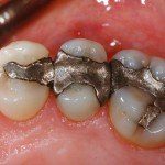 Dental amalgam fillings release MORE mercury when combined with WiFi exposure