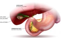 Is the Gallbladder Really “Not Needed” and OK to Routinely Remove by Surgery?