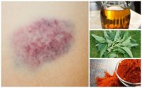 How To Get Rid Of Bruises: 12 Home Remedies That Really Work