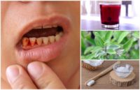 9 Best Home Remedies To Get Rid Of Gingivitis