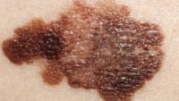 Black Salve as an Alternative Cancer Cure