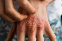 Traditional Chinese medicine is a safe, effective alternative for treating psoriasis