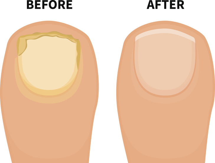 Top 10 Home Remedies To Get Rid Of Toenail Fungus Fast