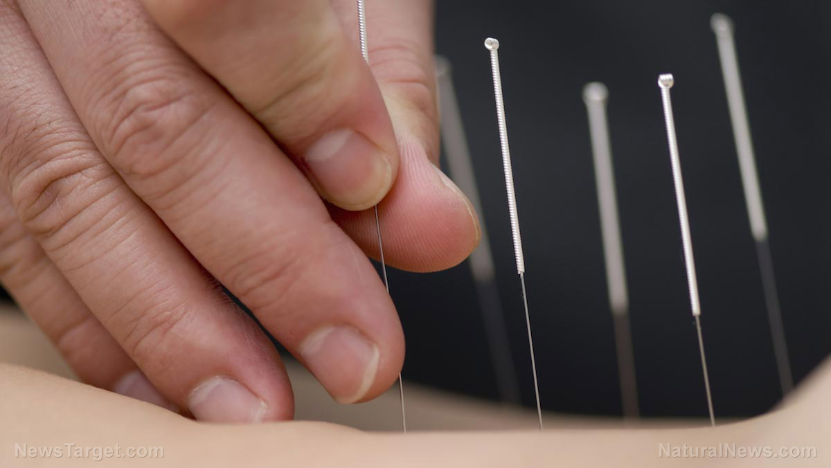 Arthritic pain can be reduced with sinew acupuncture