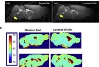 Study: Neuroprotective Effect of Virgin Coconut Oil Helps Relieve ALS (Lou Gehrig Disease)