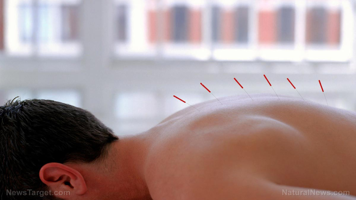 Acupuncture is an effective treatment for headaches associated with traumatic brain injury: Study