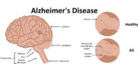 Blood Test Could Predict Alzheimer’s More than 15 Years Before Onset