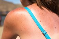 4 Essential Oils That Quickly Relieve Sunburn