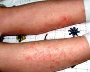 Eczema and psoriasis linked to liver health