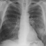 The root cause of your pneumonia risk revealed