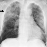 Vitamin C infusion for the treatment of severe 2019-nCoV infected pneumonia