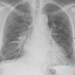 High-dose glutathione shows promise in addressing respiratory distress in patients with COVID-19