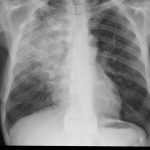 Safe vitamin therapy for reduction of cytokine storms in acute respiratory distress syndrome, NEW study