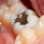 DANGER in your mouth: The true risk linked to “silver” dental fillings