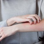 Looking for natural eczema relief? These 6 remedies deliver impressive results