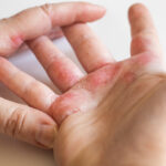 Ease symptoms of eczema by eliminating THESE foods